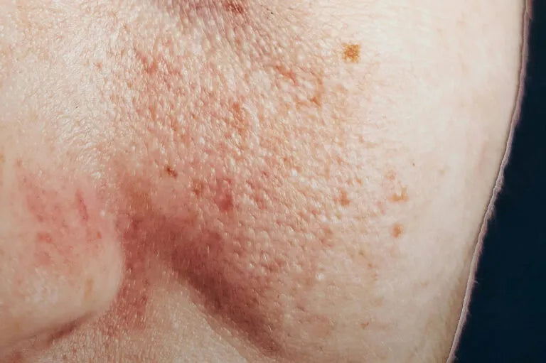 Irritationen & Rötungen: sensible Haut beruhigen